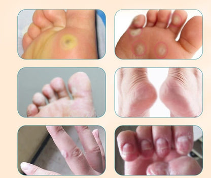 Foot Corn Removal Plaster